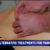 4 Your Health Cupping for Pain Relief CBS 4 Indianapolis News Weather Traffic and Sports WTTV